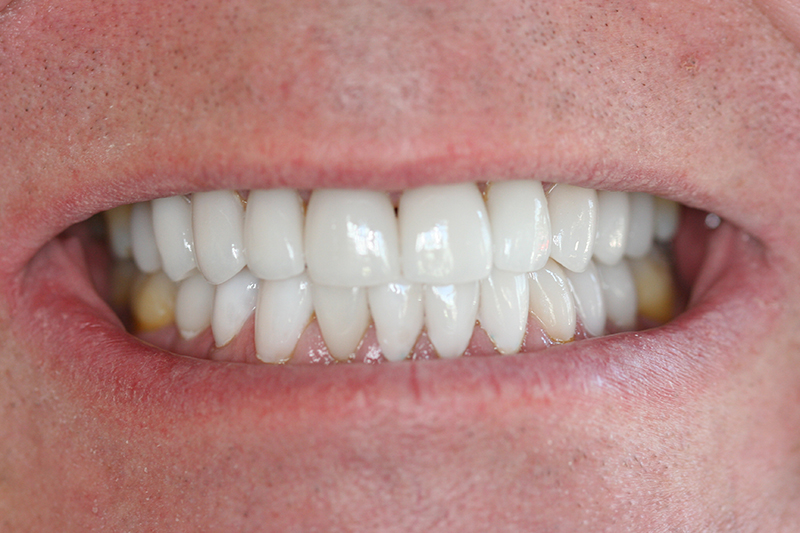 Case 1 – After treatment