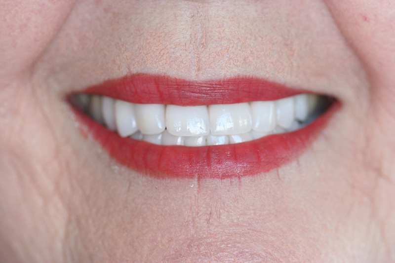 Case 2 – After treatment