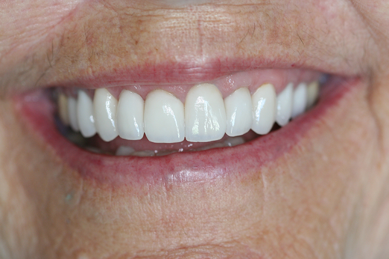 Case 3 – After treatment
