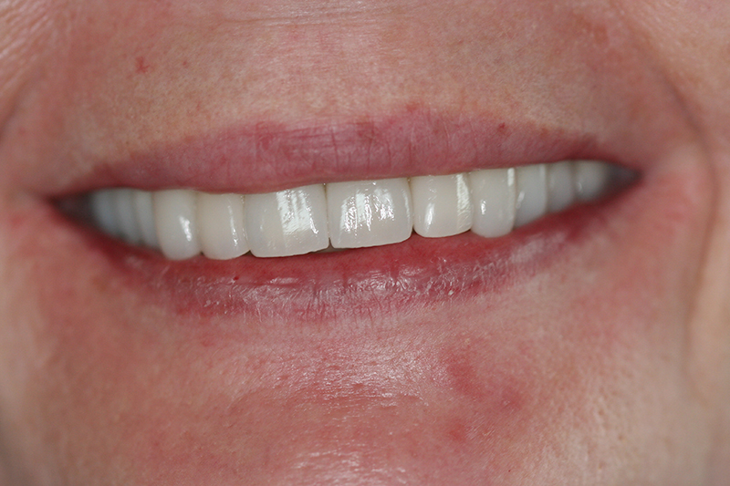 Case 4 – After treatment