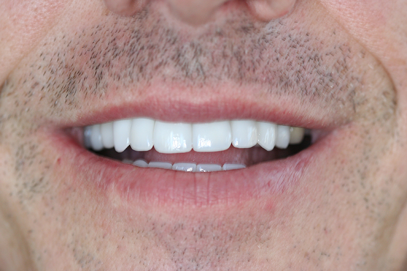 Case 5 – After treatment