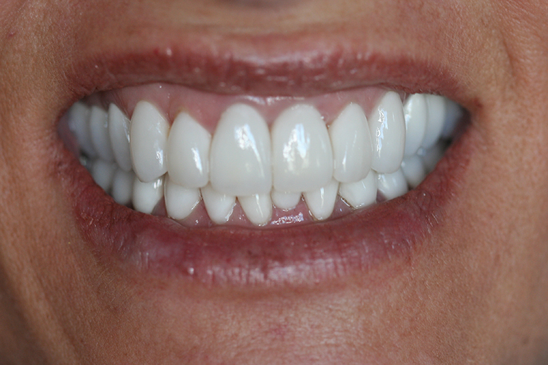 Case 6 – After treatment