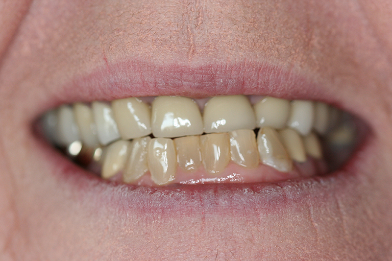 Case 2 – Before treatment