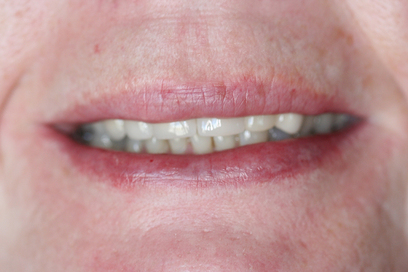 Case 4 – Before treatment